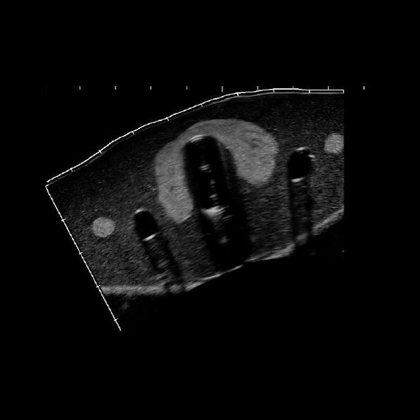 Fantôme échographie biopsie thyroïde - vue sous échographie
