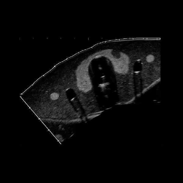 Fantôme échographie biopsie thyroïde - vue sous échographie