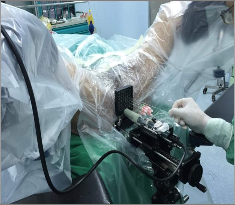 Recommandations et optimisation de l’échoguidage pour la biopsie de prostate